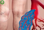 HUYẾT KHỐI TĨNH MẠCH LÀ CĂN BỆNH NGUY HIỂM CẦN PHÁT HIỆN SỚM